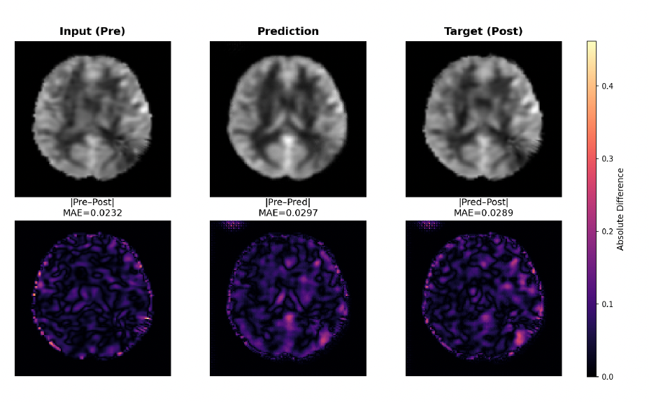 Pre-acetazolamide input, generated post-acetazolamide slice and ground truth, with absolute-difference maps below